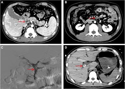 Case Report: PROS1 (p.Leu584Arg) pathogenic mutation causes portal and superior mesenteric venous thromboembolism